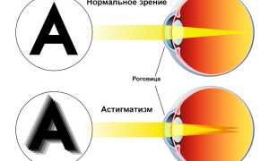 Астигматизм и катаракта: причины и лечение