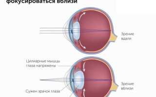 Причины избыточного напряжения аккомодации у людей