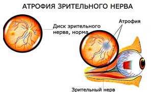 Развитие отёка зрительного нерва — информация, которую важно знать для здоровья