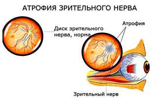 Развитие отёка зрительного нерва — информация, которую важно знать для здоровья
