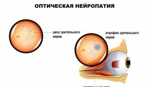 Причины и терапия атрофии зрительного нерва: важные аспекты и рекомендации