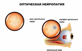 Причины и терапия атрофии зрительного нерва: важные аспекты и рекомендации