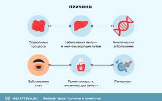 Причины пожелтения белков глаз у новорождённых — симптомы, лечение и профилактика