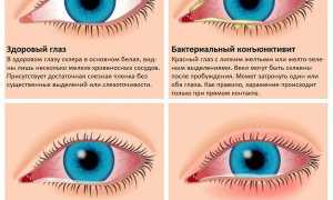 Причины герпетического конъюнктивита, симптомы и лечение заболевания глаз