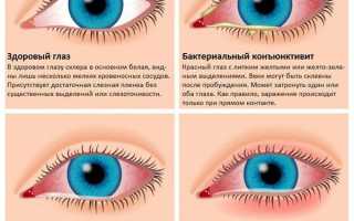 Причины герпетического конъюнктивита, симптомы и лечение заболевания глаз