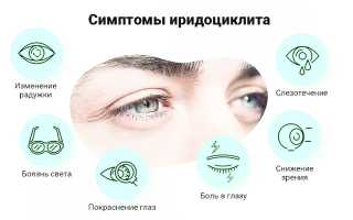 Причины, симптомы и принципы лечения иридоциклита у пациентов