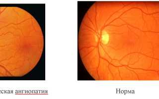 Лечение гипертонической ангиопатии сетчатки: методы и рекомендации