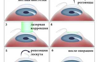 Современные методики лазерной коррекции близорукости для улучшения зрения
