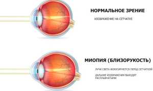 Что такое диоптрии в очках и линзах: объяснение и примеры