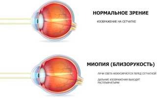 Что такое диоптрии в очках и линзах: объяснение и примеры