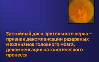 Особенности лечения застойного диска зрительного нерва у пациентов
