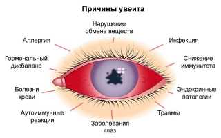 Причины, признаки и способы лечения увеита глаза: полное руководство