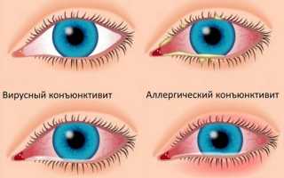 Причины, симптомы и лечение воспаления глаза: важная информация для здоровья