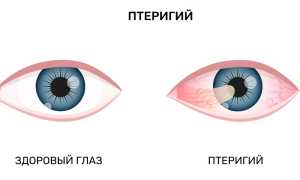 Разновидности глазных заболеваний и их симптомы