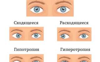 Почему косят глазки у новорождённых: причины и советы
