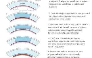 Показания к кератопластике и особенности проведения операции для улучшения зрения