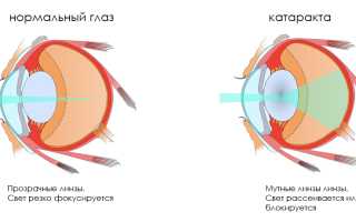 Признаки и методы лечения ядерной катаракты глаз: полезная информация
