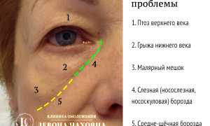 Причины мешков под глазами и их устранение