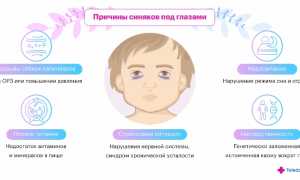 Причины синяков под глазами у детей: что нужно знать