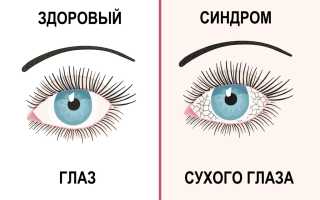 Причины сухости глаз, симптоматика, терапия и профилактика для здоровья