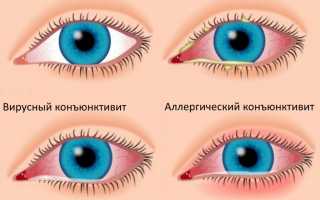 Особенности лечения конъюнктивита у детей 3 лет: важные рекомендации