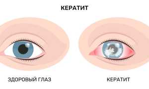 Какие глазные заболевания развиваются у детей и как их предотвратить