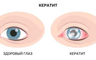 Какие глазные заболевания развиваются у детей и как их предотвратить