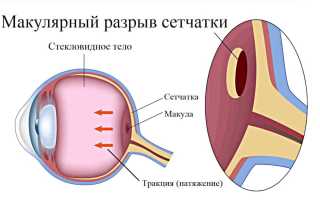 Симптомы и лечение макулярного разрыва сетчатки: важные аспекты здоровья