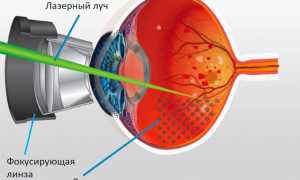 Особенности проведения лазерной коагуляции сетчатки глаза: важные аспекты и рекомендации
