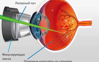 Особенности проведения лазерной коагуляции сетчатки глаза: важные аспекты и рекомендации