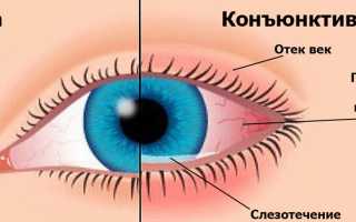 Как лечить конъюнктивит у ребёнка в домашних условиях эффективно и безопасно