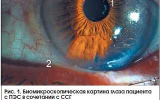 Симптомы и способы лечения псевдоэксфолиативного синдрома глаз: важные аспекты