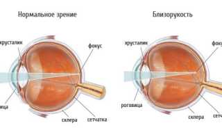 От чего может испортиться зрение – главные факторы и их влияние