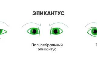 Причины формирования эпикантуса и показания к удалению «монгольской складки» у пациентов