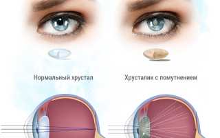 Симптомы и особенности лечения при незрелой катаракте у пациентов