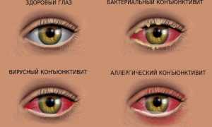 Причины, симптомы, принципы лечения конъюнктивита у взрослых