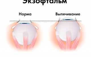 Причины экзофтальма, симптомы, лечение и профилактика заболевания глаз