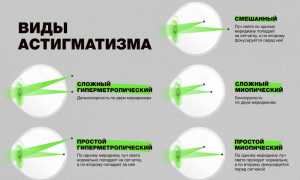 Причины гиперметропического астигматизма у детей: важные аспекты и рекомендации
