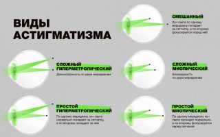 Причины гиперметропического астигматизма у детей: важные аспекты и рекомендации