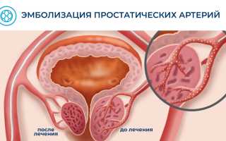 Эмболизация артерий аденомы простаты отзывы врачей опыт