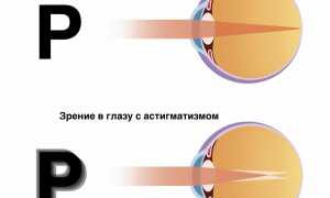 Поддаётся ли астигматизм лечению: важные аспекты и рекомендации