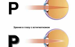 Поддаётся ли астигматизм лечению: важные аспекты и рекомендации