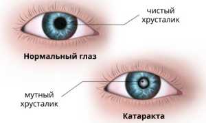 Лечение катаракты лекарственными средствами без операции: эффективные методы и рекомендации