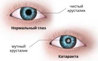 Лечение катаракты лекарственными средствами без операции: эффективные методы и рекомендации