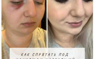 Как можно замаскировать синяки под глазами быстро и эффективно