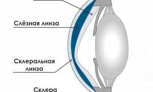 Особенности применения склеральных линз для коррекции зрения