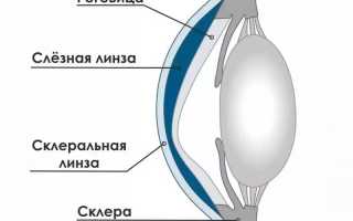 Особенности применения склеральных линз для коррекции зрения