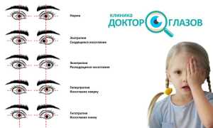 Причины и лечение косоглазия у новорождённых: важные аспекты