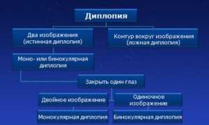 Причины двоения в глазах и их последствия