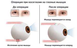 Принципы лечения косоглазия у взрослых: важные аспекты и рекомендации